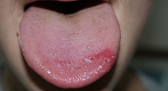 Glosodinia - senzatia de arsura a cavitatii bucale