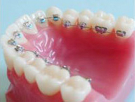 Tratamentul ortodontic: tehnica linguala