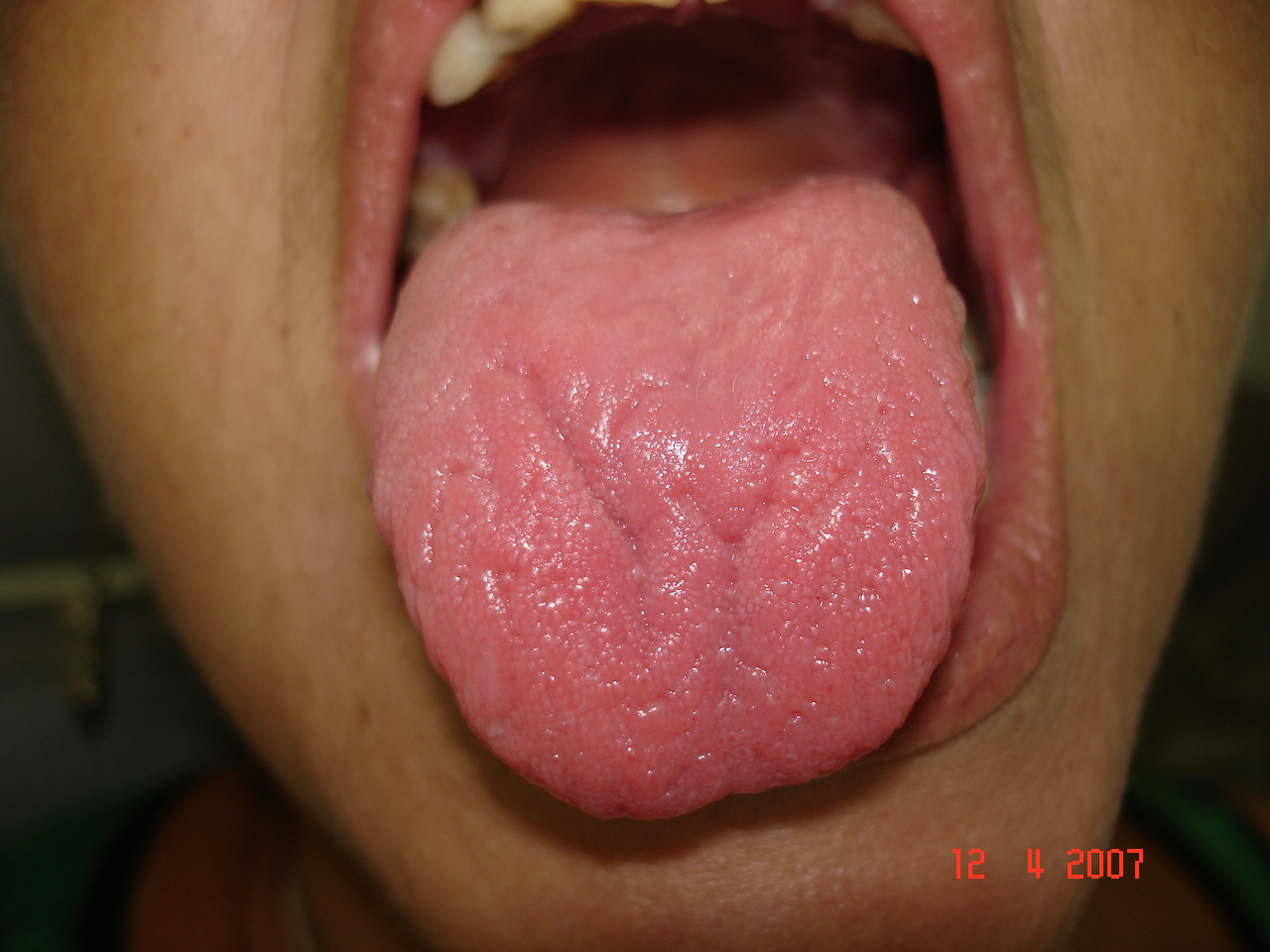 Glosodinia sau sindromul gurii care arde - cauze și tratament - IVORY Dentfix