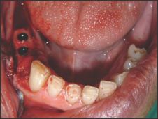 Implanturi imediate în regiunile laterale mandibulare