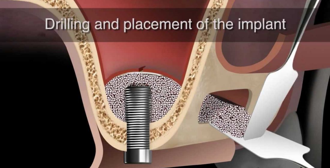 Regenerarea osoasa la nivelul sinusului maxilar in Implantologie