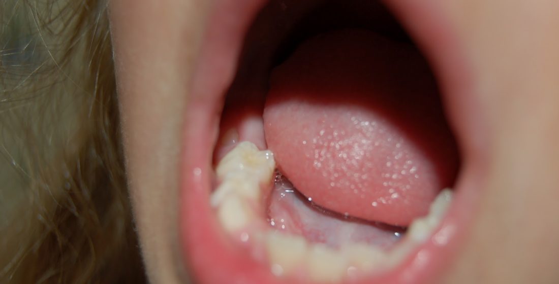 Molarul de 6 ani primul dinte permanent aparut la copii