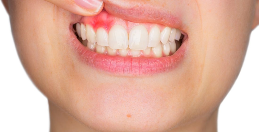 Optiuni de tratament pentru abces dentar