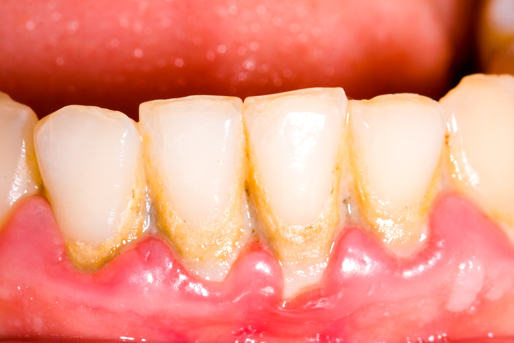 Influeiența plăcii bacteriene asupra dinților și gingiilor