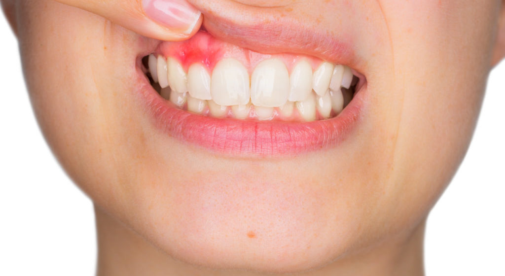 Cele mai frecvente cauze ale aparitiei abcesului dentar