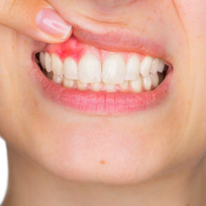 Cele mai frecvente cauze ale aparitiei abcesului dentar